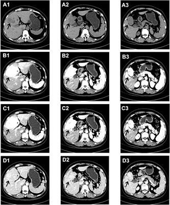 Case Report: A rare case of primary paraganglioma of the gallbladder with a literature review